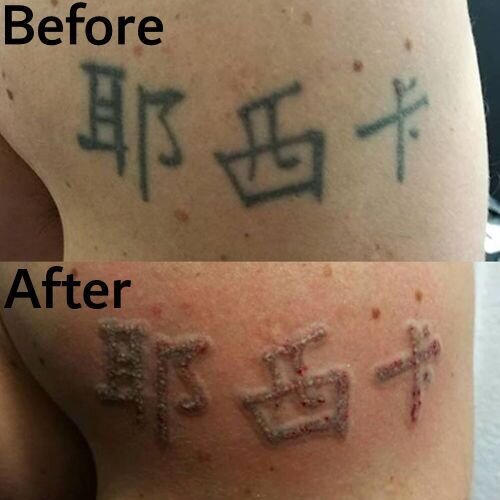 image of laser tattoo removal 
